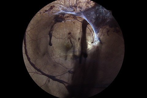 Rétinopathie diabétique