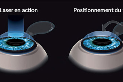 Chirurgie Réfractive