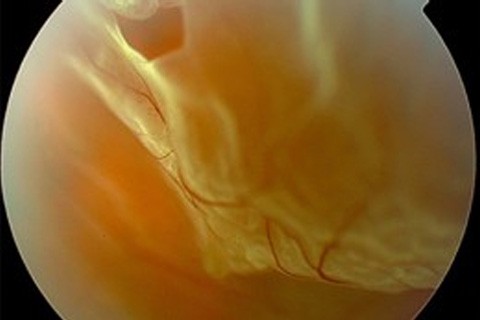 Rétine chirurgicale