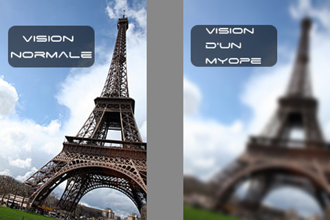 Myopie - Presbytie
